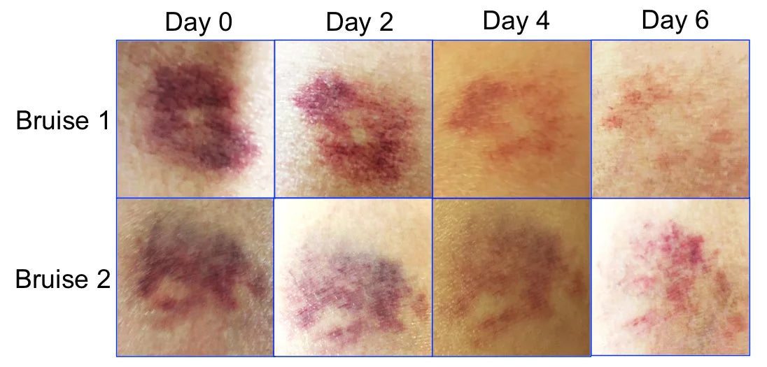 ONE pack- bruise NO by BruiseGONE Natural healing CREAM, WEEK, Speeds bruise 3 remedy