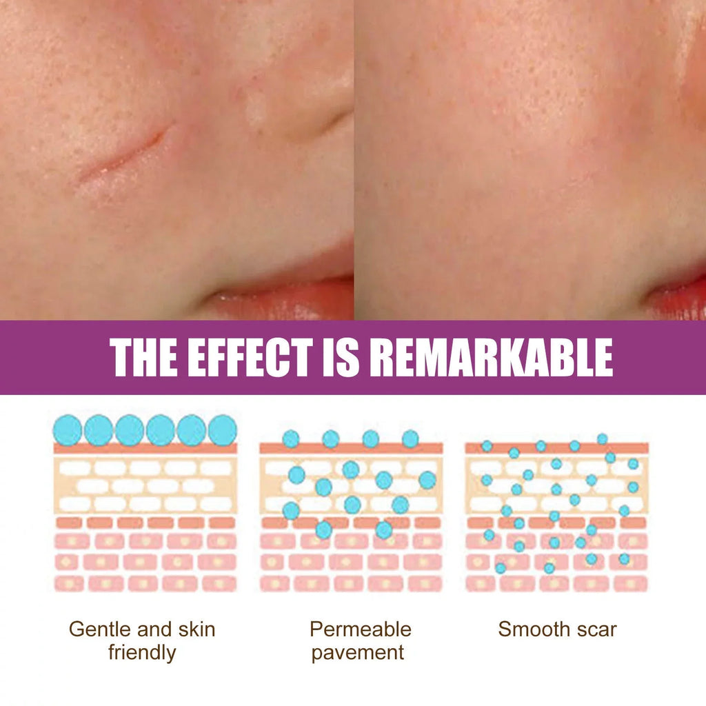 Scar Scar Removal Repair Scar Skin 50ml Repair Cream 2PCS and Cream Removal