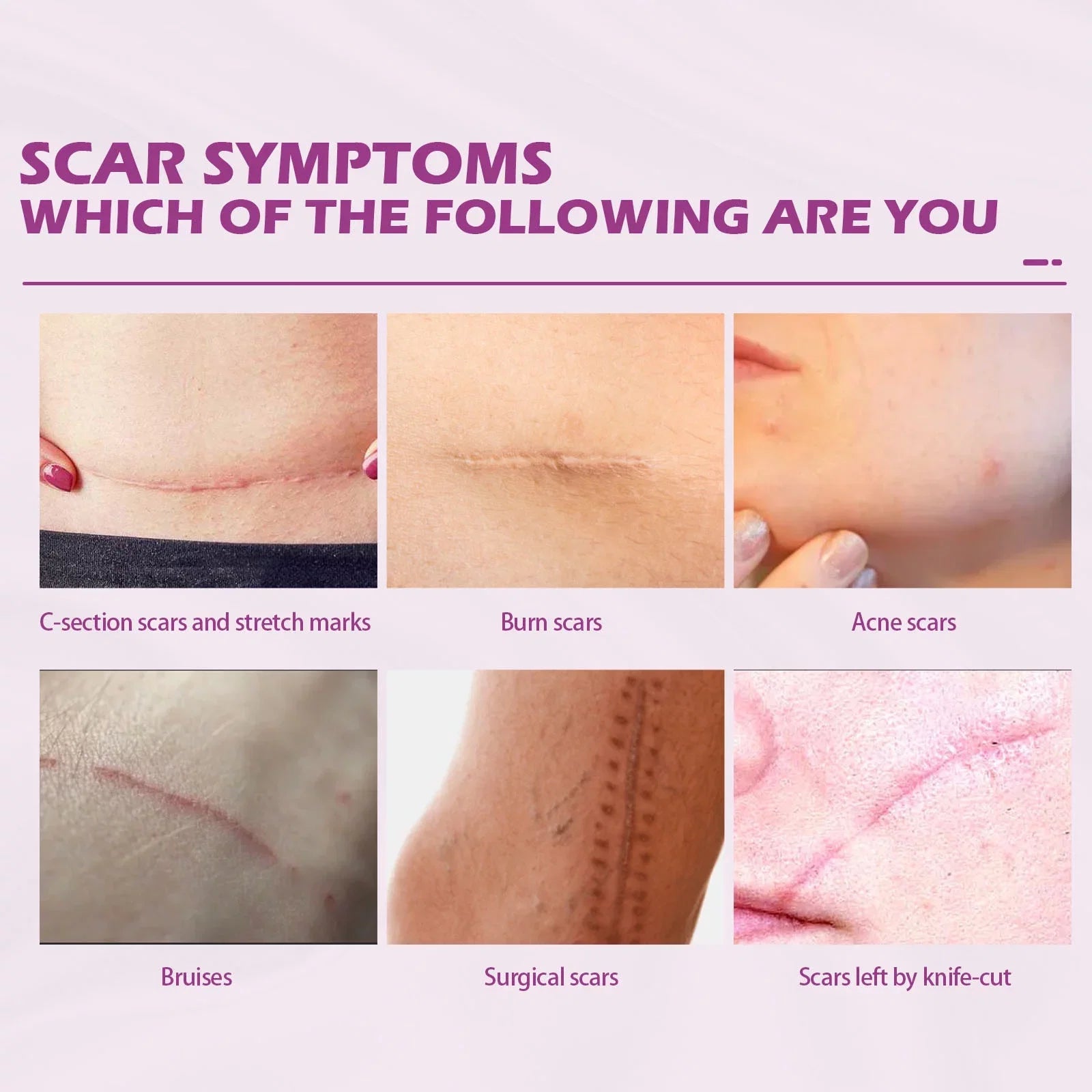 Scar Scar Removal Repair Scar Skin 50ml Repair Cream 2PCS and Cream Removal